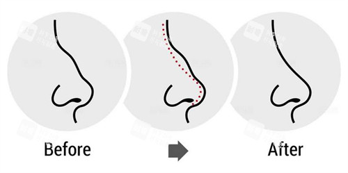 驼峰鼻子的改变过程图