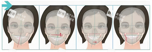 正颌手术手术步骤展示动画图