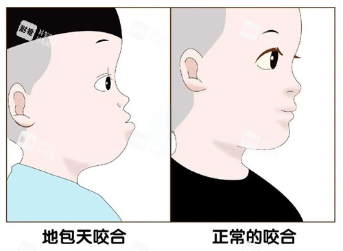 地包天和正常对比图