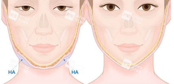 馒化脸改善前后变化