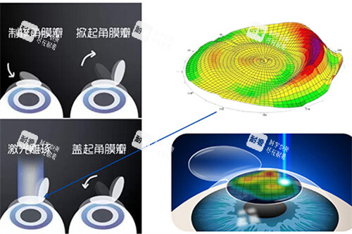 激光近视手术过程示意图 激光近视手术过程示意图