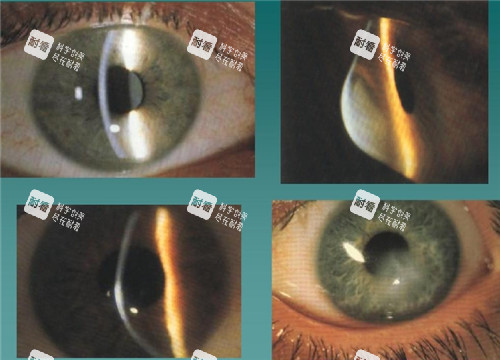 圆锥角膜视力表现照片