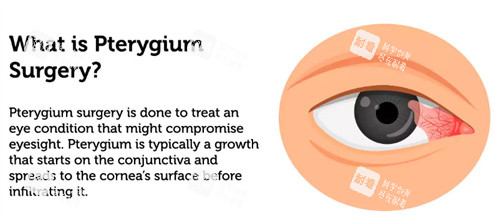 什么是眼睛翼状胬肉