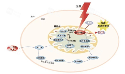 光动力治疗黄斑眼病原理图解 光动力治疗黄斑眼病原理图解