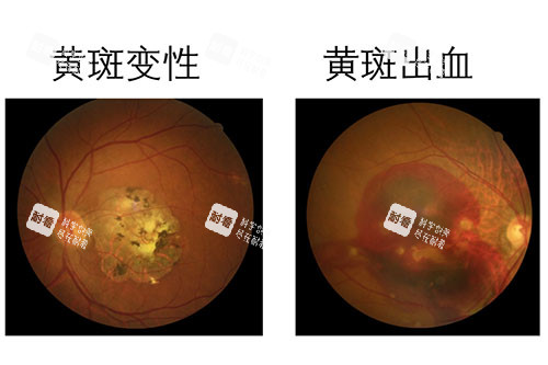 黄斑变性卡通图片展示 黄斑变性卡通图片展示
