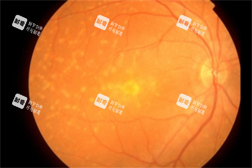 眼底黄斑示意图 眼底黄斑示意图