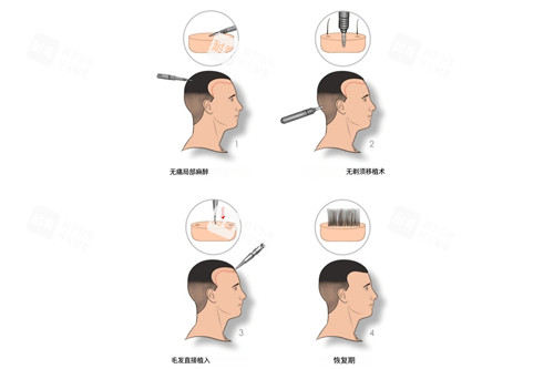 不剃发植发示意图