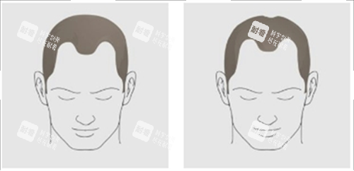 发际线后移类型
