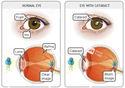 晶体置换晶体和眼睛的表现 晶体置换晶体和眼睛的表现