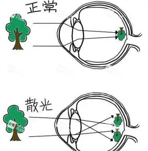正常眼睛和散光眼睛呈现不同 正常眼睛和散光眼睛呈现不同