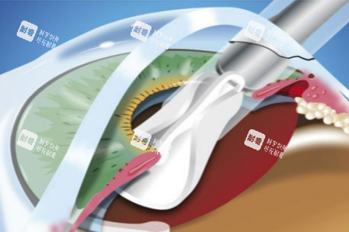 白内障超声乳化术 白内障超声乳化术