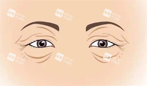 衰老的双眼皮
