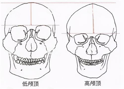 高颅顶和低颅顶的区别