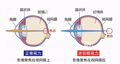 老花眼和正常视力