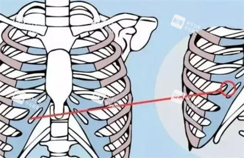 肋软骨隆鼻肋部展示图