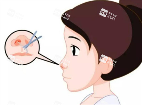 隆鼻切口的位置图解