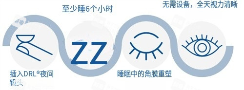 角膜塑形镜矫正过程