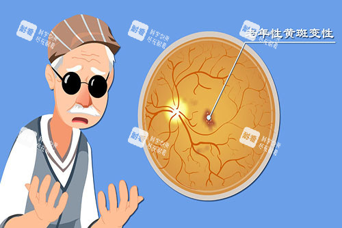 老年性黄斑病变卡通图