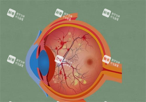 视网膜色素变性的眼睛