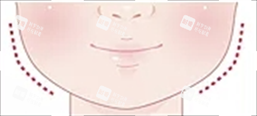 适合打玻尿酸面部轮廓