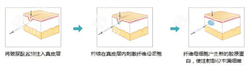 玻尿酸塑型原理