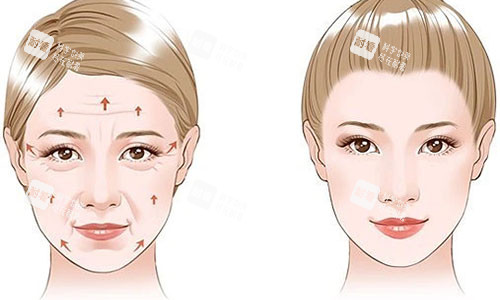 拉皮手术前后对比图