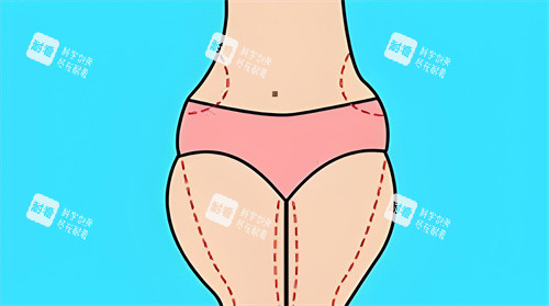 腿部吸脂手术吸脂部位动画图 腿部吸脂手术吸脂部位动画图
