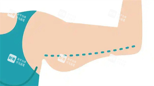 手臂吸脂前 手臂吸脂前