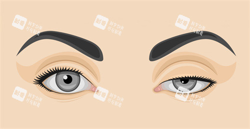 双眼皮修复前后对比 双眼皮修复前后对比