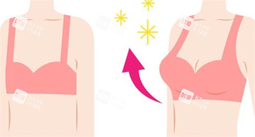 隆胸前后对比 隆胸前后对比