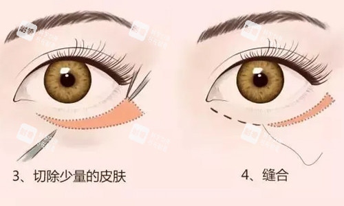 外切祛眼袋展示图