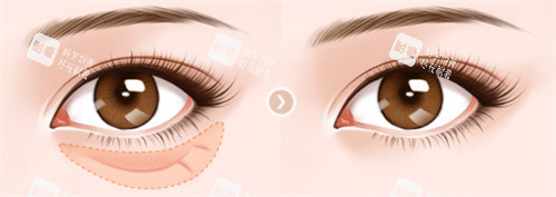 眼袋对比图 眼袋对比图