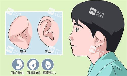 耳朵整形示意图