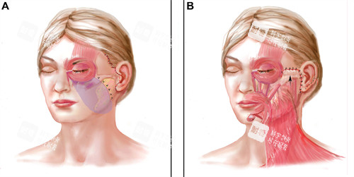 面部提升手术改善部位 面部提升手术改善部位