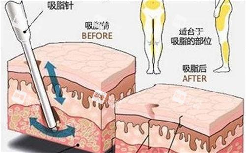 吸脂前后脂肪数量变化对比