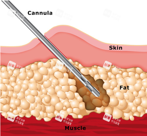 吸脂手术动画演示