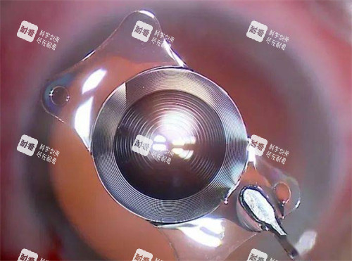 白内障晶体展示 白内障晶体展示