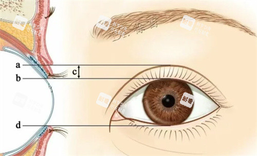 PARK法双眼皮素材 PARK法双眼皮素材
