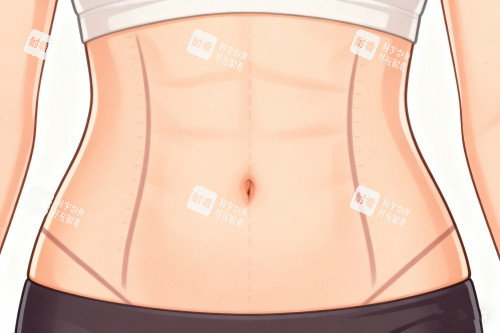 腹壁成型术成果一览 腹壁成型术成果一览