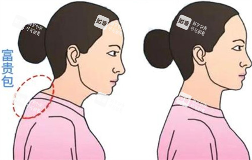 富贵包去除前后对比