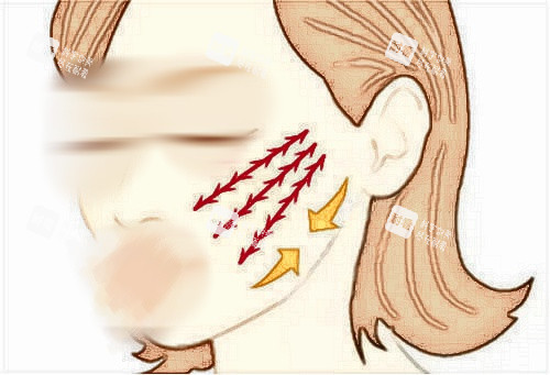 拉皮手术面部提拉示意图.jpg 拉皮手术面部提拉示意图.jpg