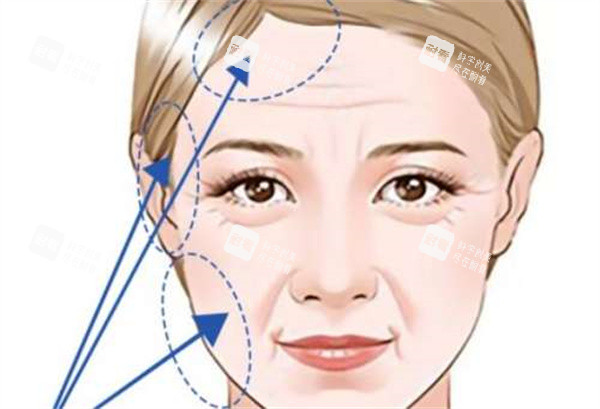 拉皮整形手术 拉皮整形手术