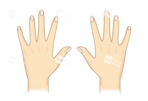 手背拉皮术后示意图 手背拉皮术后示意图