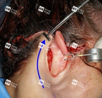 拉皮手术切口图