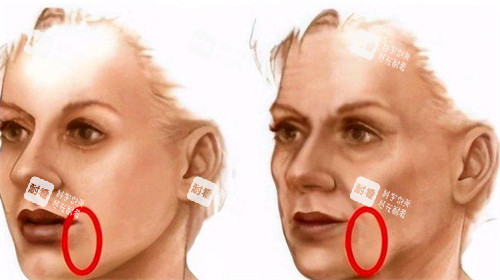 口角囊袋展示图 口角囊袋展示图