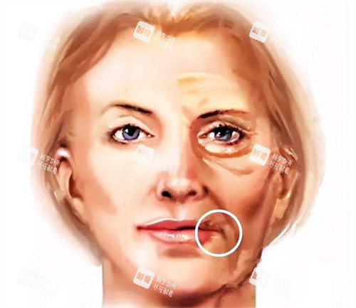 口角囊袋图示 口角囊袋图示