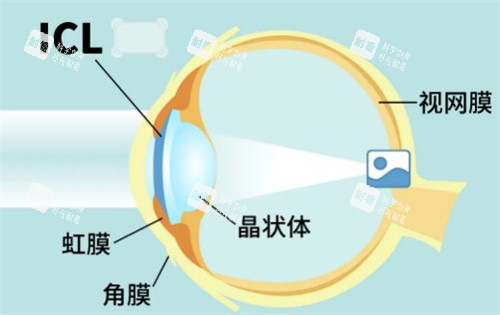 ICL植入卡通图 ICL植入卡通图