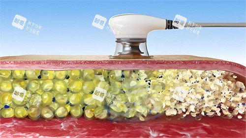 超声波溶脂过程演示图 超声波溶脂过程演示图