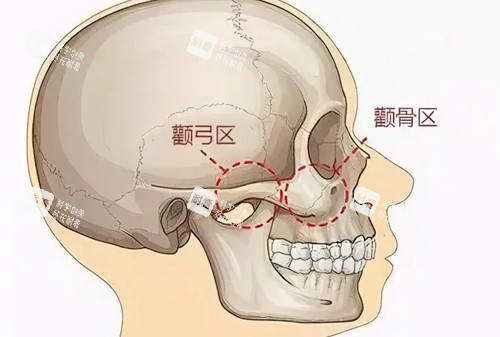 颧弓颧骨位置示意图 颧弓颧骨位置示意图