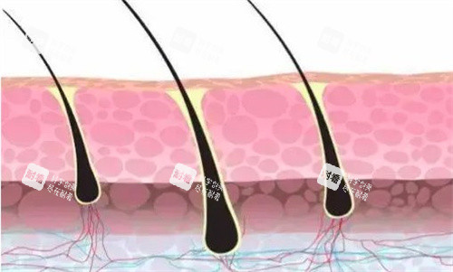 植发的毛囊 植发的毛囊